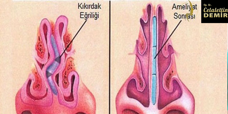 Burun Kemik Eğriliği Ameliyatı