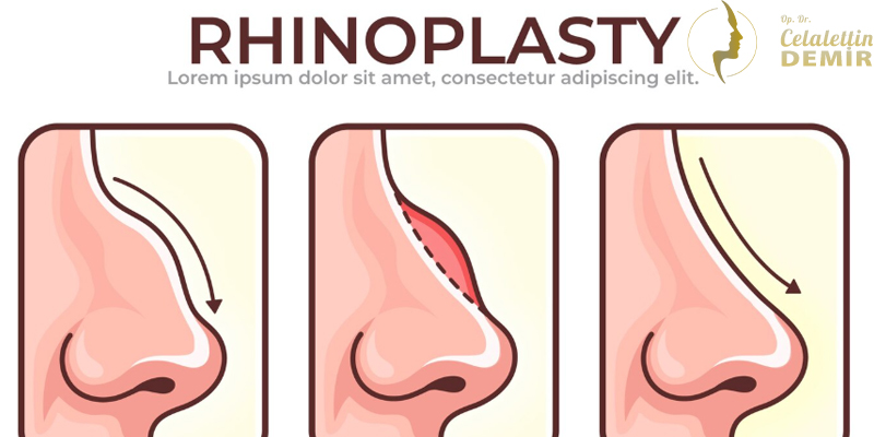 Rinoplasti 800X400